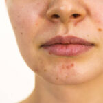 Skin barrier repair skincare with moisturizer and gentle hydration
