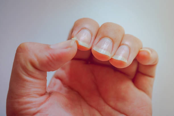 Close-up of a brittle fingernail with a split edge