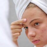 Teen Acne: Causes, Treatments & Simple Skincare Routine
