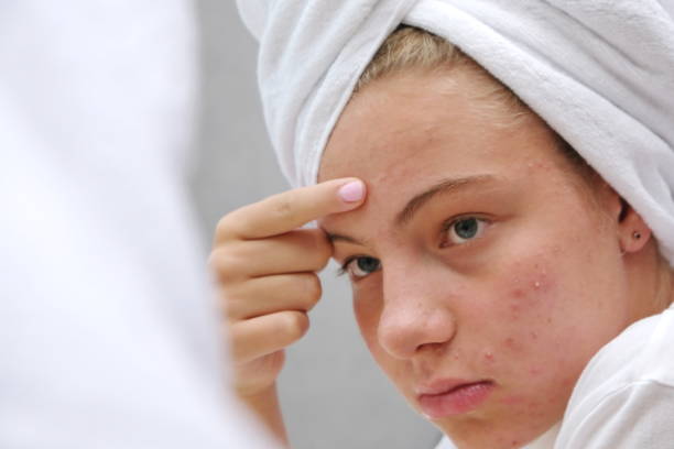 Teen Acne: Causes, Treatments & Simple Skincare Routine