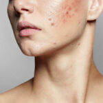 Adult Acne: Causes, Treatments & Skincare Tips for Clearer Skin