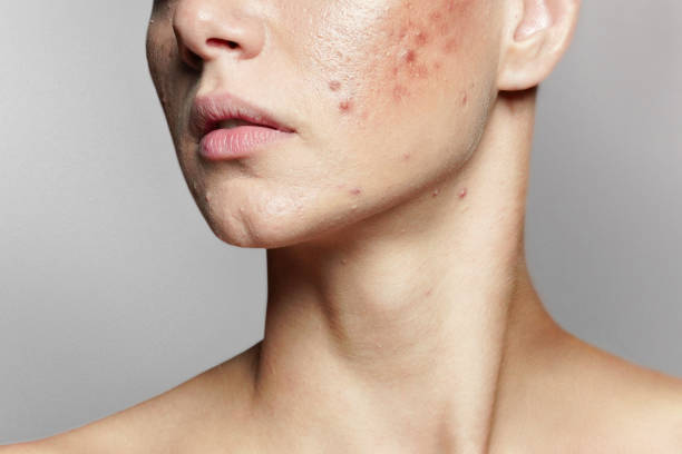 Adult Acne: Causes, Treatments & Skincare Tips for Clearer Skin