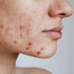 Hormonal Acne Guide: Causes, Symptoms, Treatments & Skincare