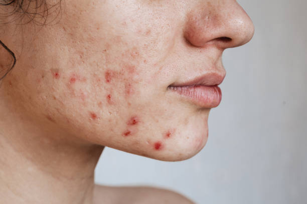 Hormonal Acne Guide: Causes, Symptoms, Treatments & Skincare