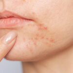 How to Get Rid of Acne: A Simple, Evidence-Based Guide That Actually Works