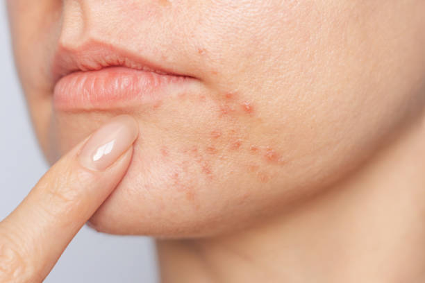 How to Get Rid of Acne: A Simple, Evidence-Based Guide That Actually Works