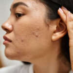 Types of Acne Explained: Blackheads, Whiteheads & More