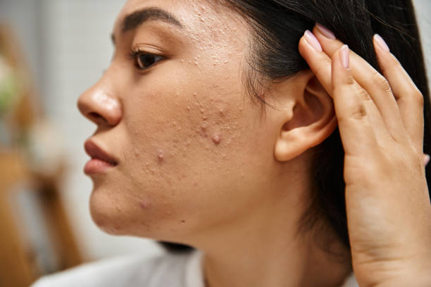 Types of Acne Explained: Blackheads, Whiteheads & More