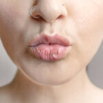 Chapped Lips: Causes, Treatment & 15 Easy Lip Care Tips