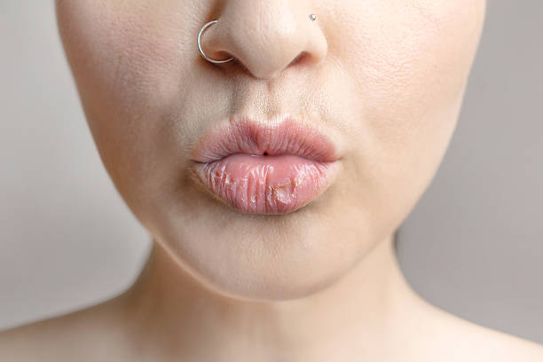 Chapped Lips: Causes, Treatment & 15 Easy Lip Care Tips