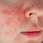 Close-up of irritated facial skin with redness and dry texture