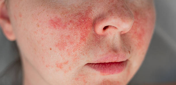 Close-up of irritated facial skin with redness and dry texture
